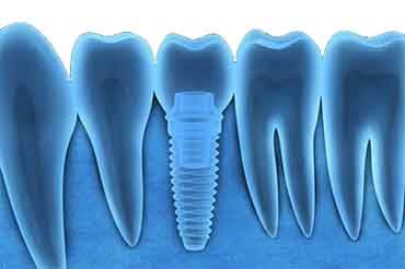 FAQs - Dental Care, Glebe, Sydney, NSW, Australia